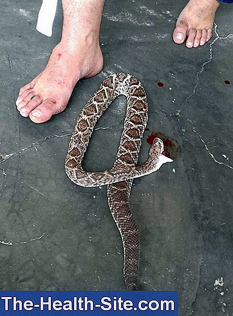 Mordida De Cobra Sintomas Consequ Ncias Primeiros Socorros Terapia