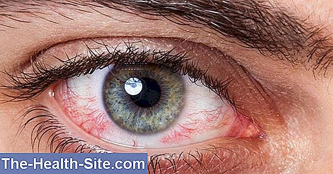 afectarea vizuală a corneei vederea se deteriorează până la