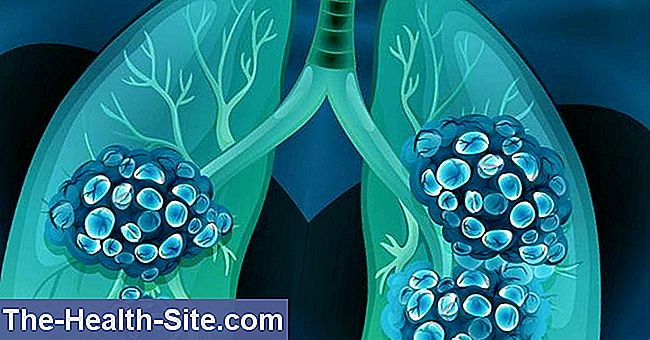 Nsclc: nesīkšūnu plaušu vēzis