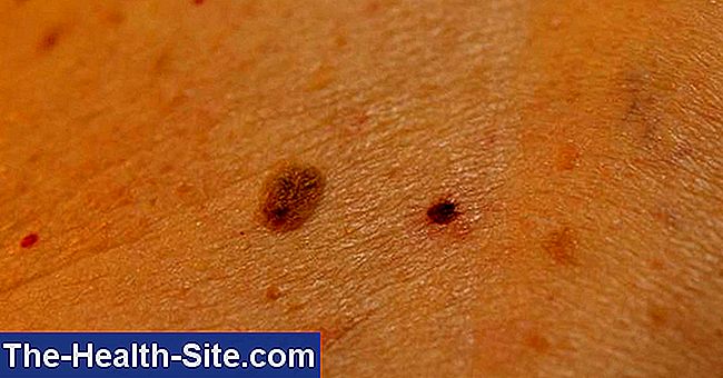 Skin cancer - symptomen