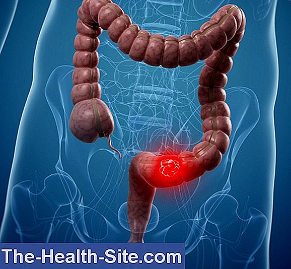 Better Early Detection Of Colon Cancer 💊 ScientificPractical Medical