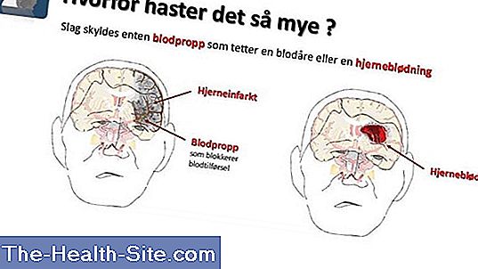 hjerneblødning symptomer kvinder