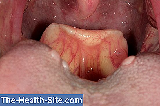 Epiglotitis