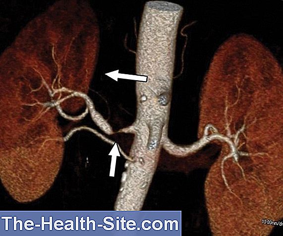 Renal Artery Stenosis Causes Treatment Prognosis 💊 Scientific Practical Medical Journal 2024 8138