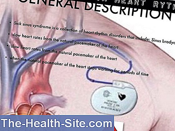 sinus-node-dysfunction-aafp