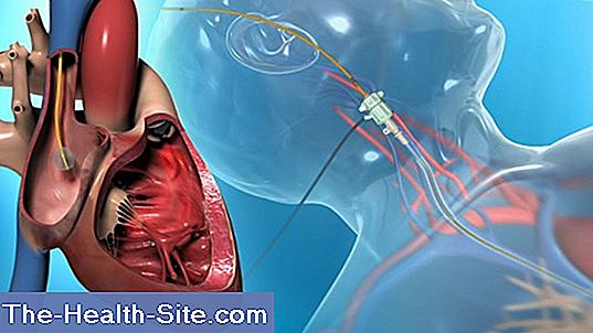 right-heart-catheter-definition-reasons-procedure-scientific