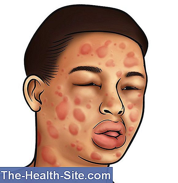 Anaphylactic Shock (Anaphylaxis) Causes, Help 💊 ScientificPractical