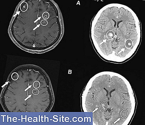 brain-metastases-causes-diagnosis-life-expectancy-scientific