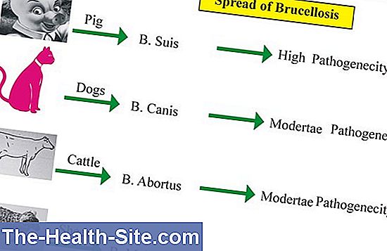 Brucellosis: Symptoms, Causes, Treatment 💊 Scientific-Practical Medical ...