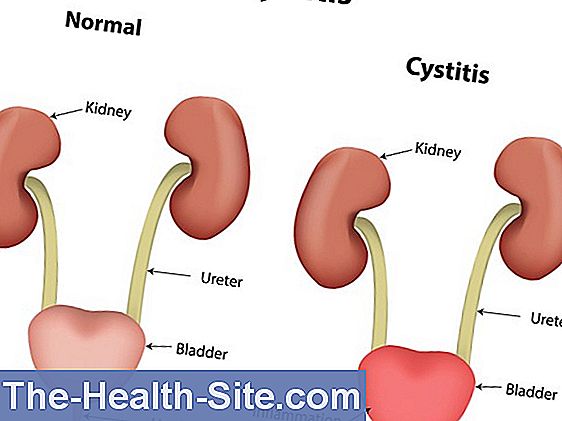 cystitis-home-remedies-what-really-helps-scientific-practical