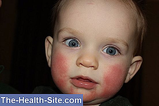 Opinion you Fifth disease in adult remarkable Fifth disease in adult apologise, but