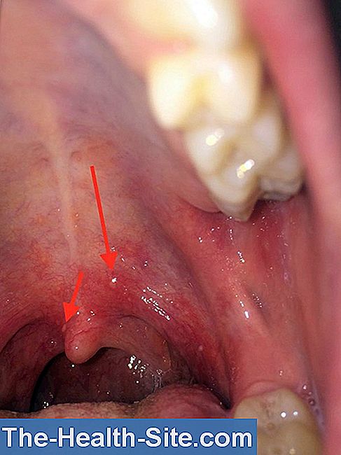 herpes-in-the-mouth-trigger-danger-of-infection-diagnosis