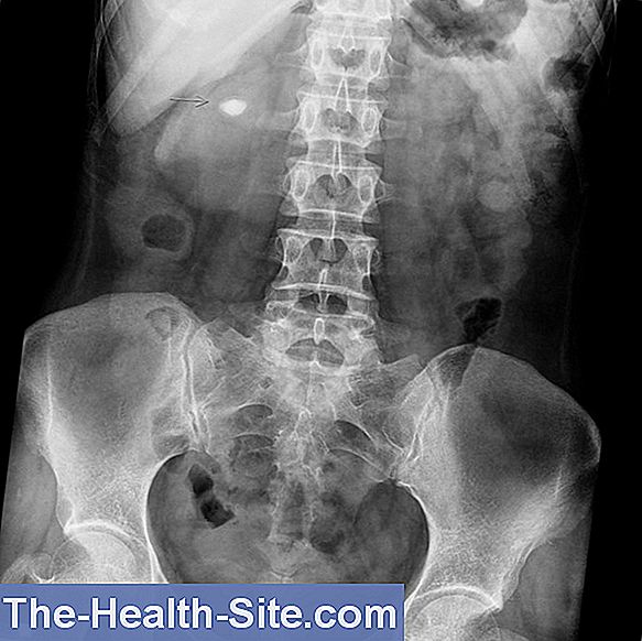 Horseshoe Kidney: Causes, Signs, Diagnosis, Consequences 💊 Scientific ...