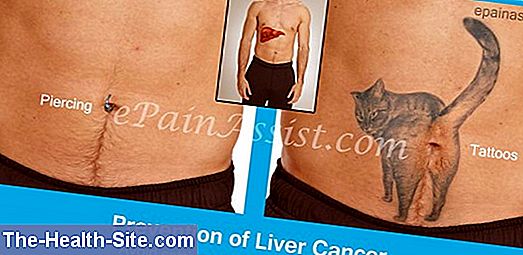 Liver cancer - symptoms