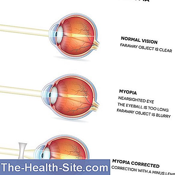 Nearsightedness