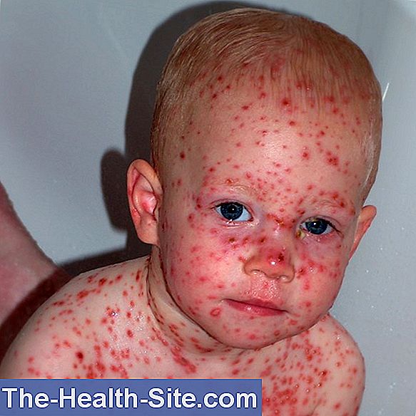 Chickenpox Infection, Symptoms, Dangers 💊 ScientificPractical Medical