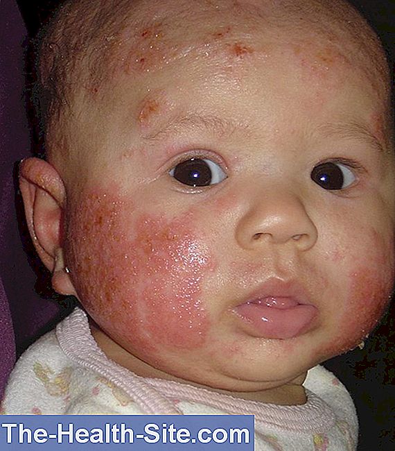 Eczema - baby