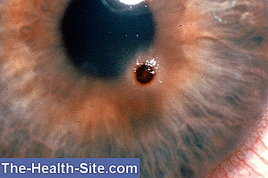 Foreign bodies in the eye - symptoms