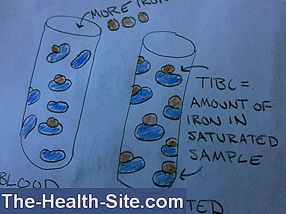 transferrin-saturation-significance-complications-scientific