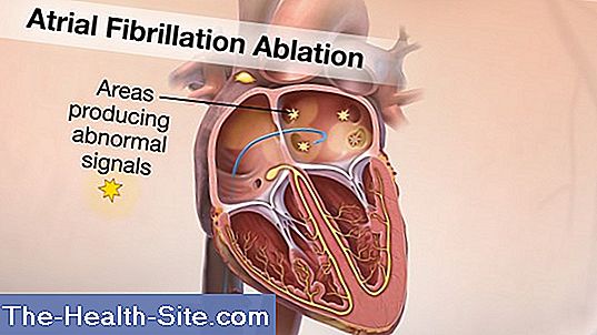 Atrial fibrillation: sealing for the heart