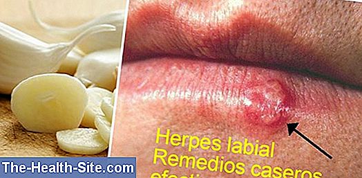 Remedios Caseros Herpes Alternativas A Las Drogas Cientifico