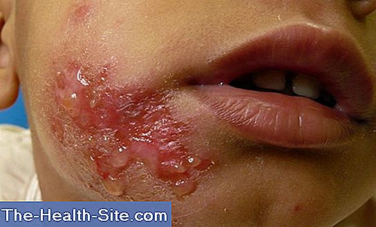 impetigo contagioso