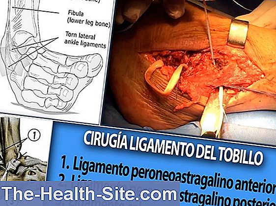 síntomas de diabetes sindesmosebandriss