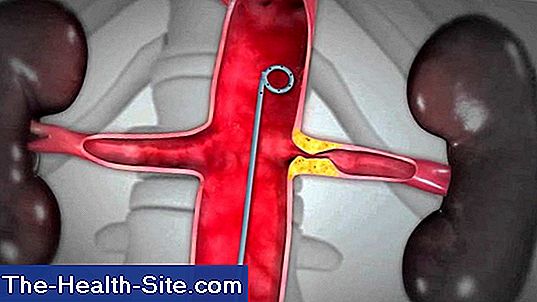 Estenosis de la arteria renal