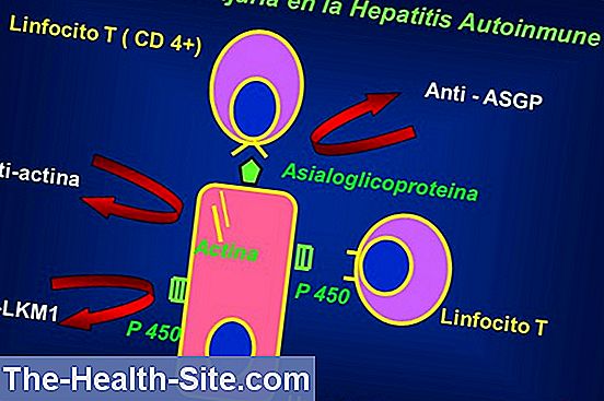 La hepatitis autoinmune