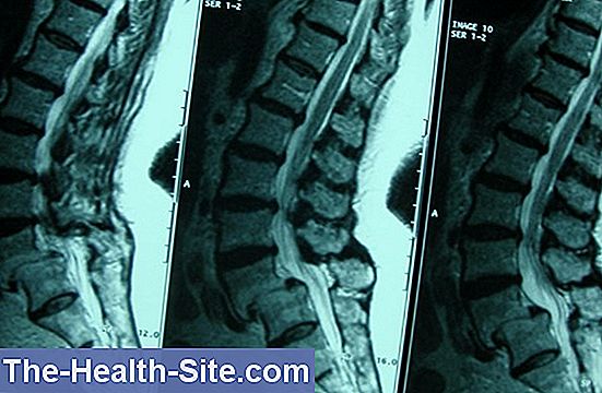 espondilolistesis