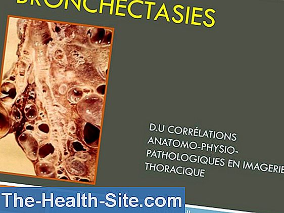 Bronchectasie Causes Traitement Pronostic 💊 Scientifique Et