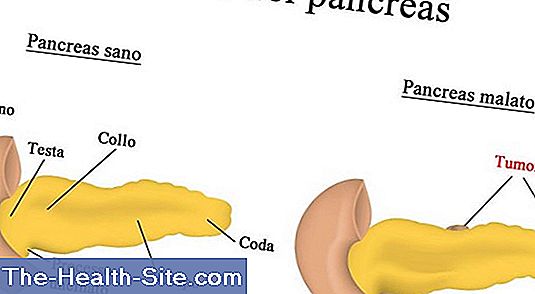 Il cancro del pancreas