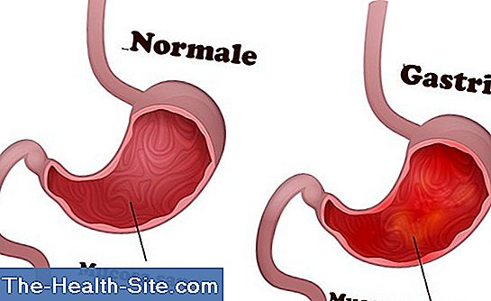 Gastrite Gastrite Sintomi Cause Scientifico Pratico Medical Journal