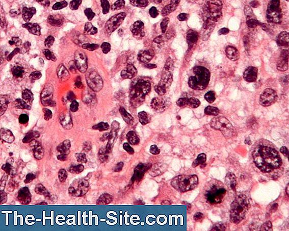 Leucemia a cellule capellute
