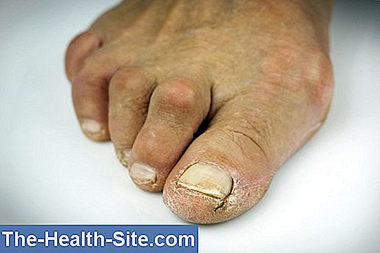 tratamentul comun al degetelor de la picioare)