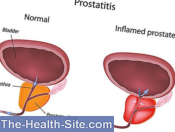 simptomele și tratamentul inflamației prostatitei cronice)