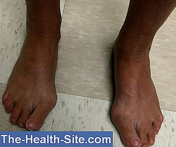 tratamentul artrozei piciorului cu picioarele plate
