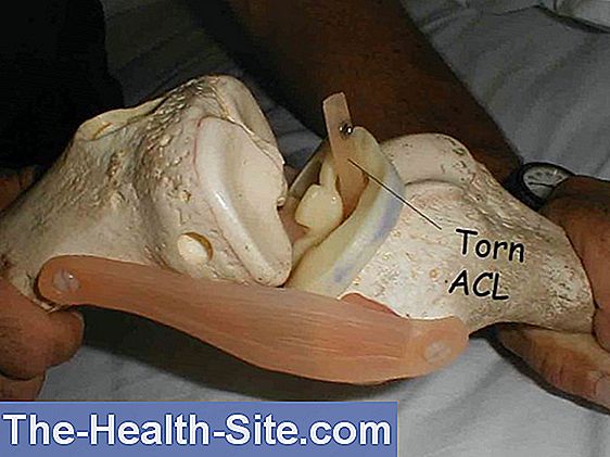 Torn acl