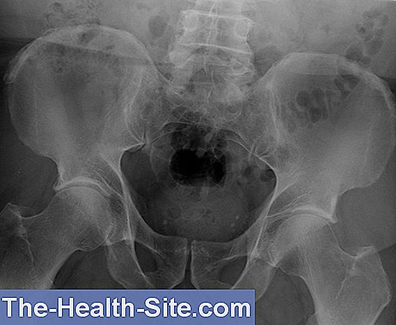 caz istoric de osteoartroză a articulațiilor șoldului