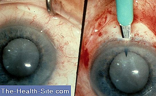 Cataract: oogdruppels in plaats van een operatie