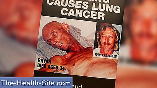 Longkanker: slechtere overlevingskans voor rokers