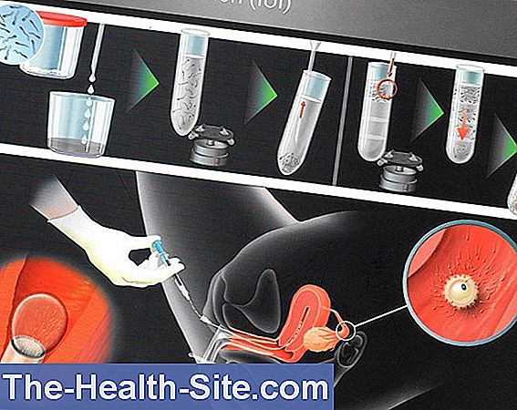 Iui: intrauterin insemination