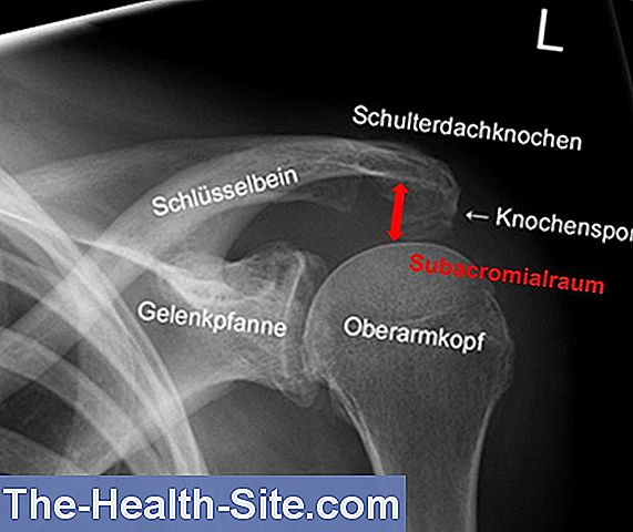 Impingement Syndrom: Utløser, Symptomer, Behandling 💊 Scientific ...