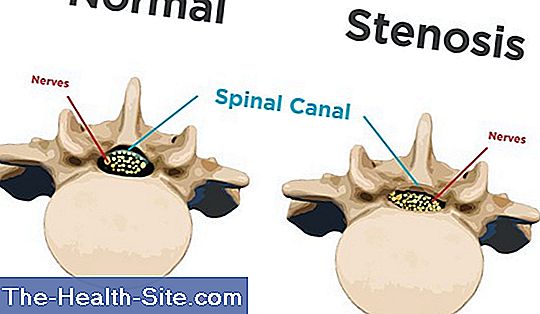 Spinal stenos