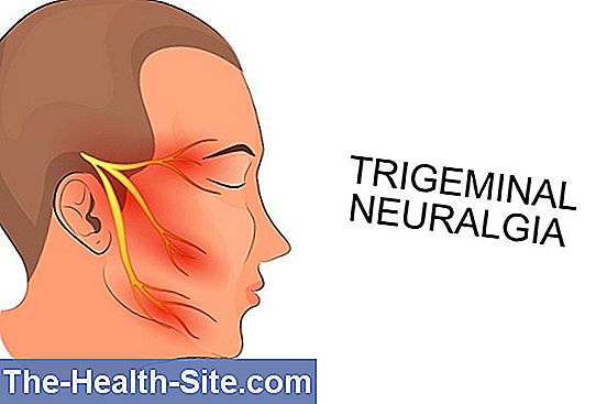 Neuralgia trigeminal