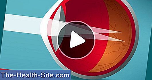 astigmatism viziune oculară ochii doare și vederea se pierde