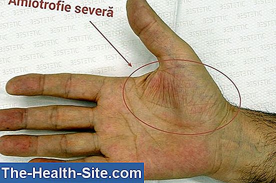 sindromul leziunilor la încheietura mâinii
