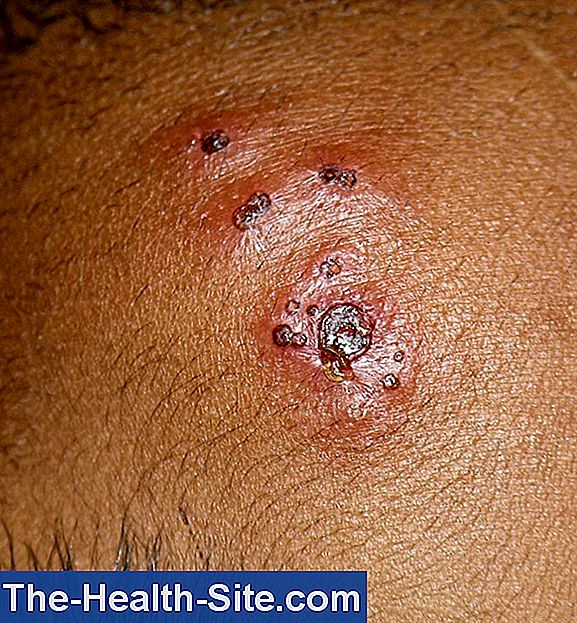 Infectiile Herpetice (virusul herpes simplex)