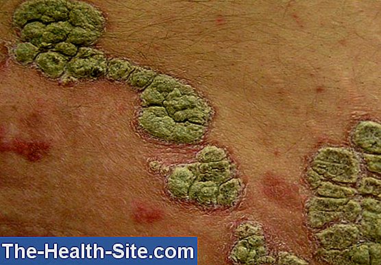 Psoriazisul: Forme, Simptome Și Cauze 💊 Științifico-Practic Medical ...