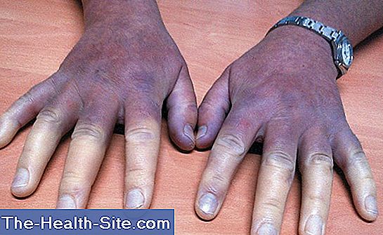 Sindrom RAYNAUD - degete amorțite și reci - Servus Expert